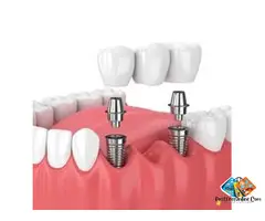 dental implants in karimnagar | Best dentist in Karimnagar