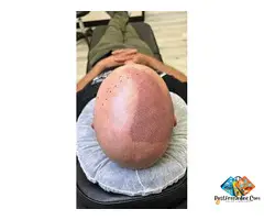 Hairline Restoration with Scalp Micropigmentation – Roseville