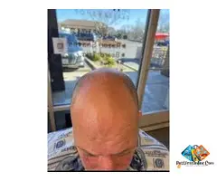 Hairline Restoration with Scalp Micropigmentation – Roseville