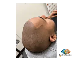 Hairline Restoration with Scalp Micropigmentation – Roseville - 6