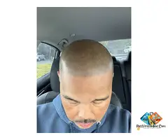 Hairline Restoration with Scalp Micropigmentation – Roseville - 7