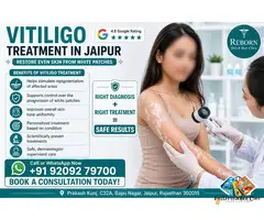 Vitiligo Treatment Jaipur - Get Safe White Patch Care