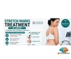 Stretch Marks Treatment in Jaipur - Get Clear and Even Skin