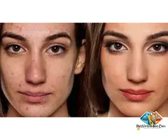 Enhance Your Profile with Non-Surgical Rhinoplasty Chiswick