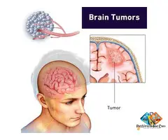 Brain Tumor V/S Brain Cancer: What is the Difference? Know All About It Before Considering Brain Tum - 1