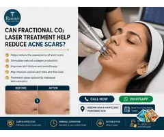 Can Fractional CO₂ Laser Improve the Appearance of Acne Scars?
