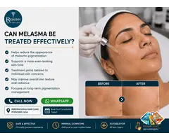 Why Does Melasma Keep Coming Back?