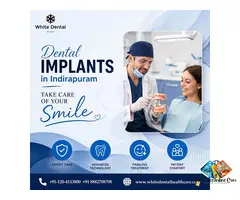 Dental Implants in Indirapuram for Missing Teeth