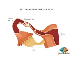 Blocked Fallopian Tubes: Symptoms, Causes and Advanced Treatment Options in Chennai
