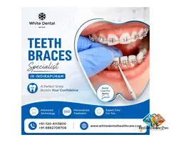 Teeth Braces Specialist in Indirapuram for Orthodontic Care